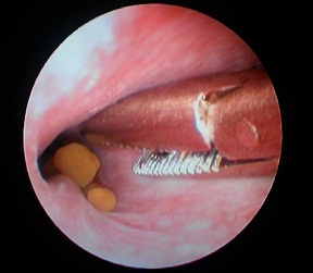 LAPAROSCOPICALLY ASSISTED SURGERY